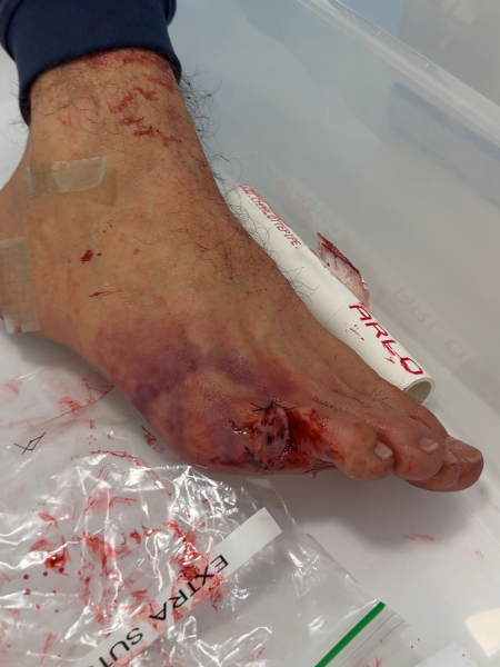 A prosthetic foot with the pinky toe missing from the Euphoria special effect designer